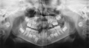 Dental Radiographs (X-Rays) - Pediatric Dentist in Englewood, NJ